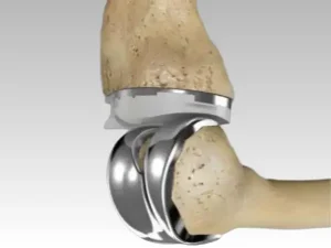 Forgecise Orthopedic Implants